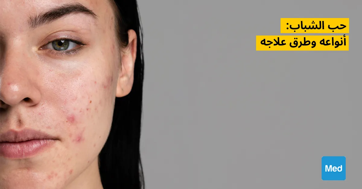 حب الشباب: أنواعه وطرق علاجه